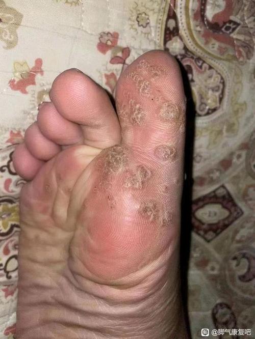 脚病毒感染传染吗