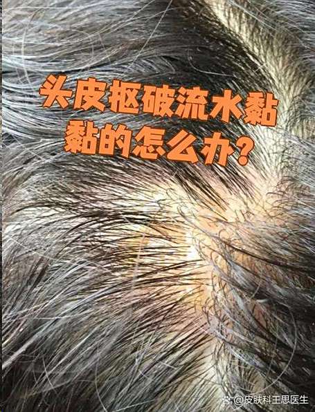头皮出像水一样的东西