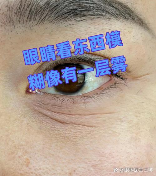 一只眼睛突然模糊看不清像有层雾