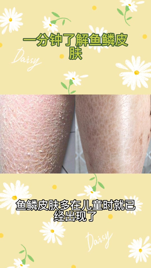 蛇皮治什么病