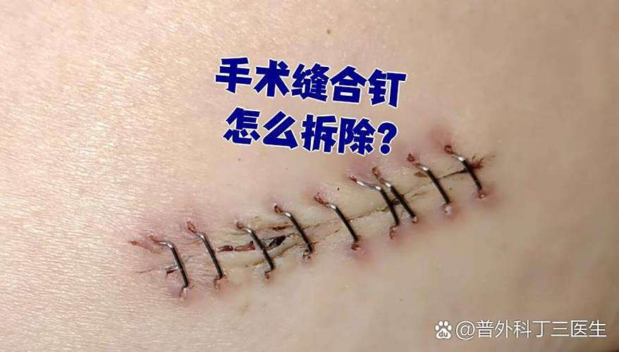 钉子如何拆卸