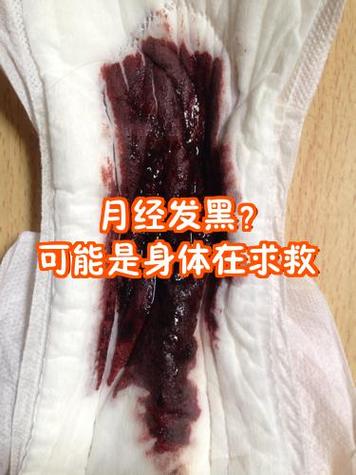 月经黑渣很脏像泥就是下不来血