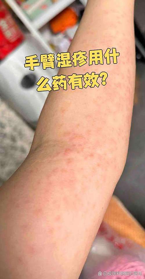 湿疹变成一层干皮要警惕