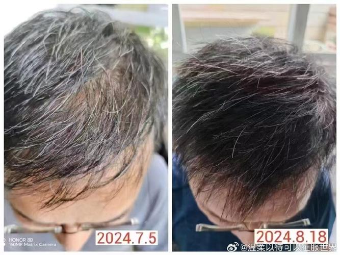 白发怎么转黑最有效的方法