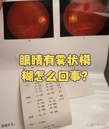 眼睛模糊像蒙了一层雾
