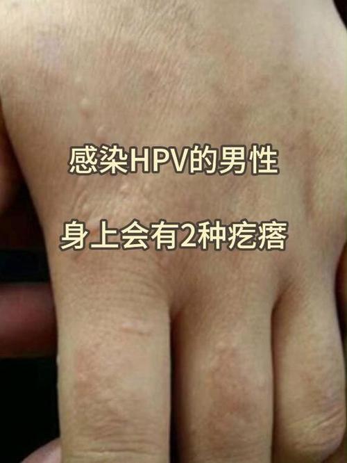 hpv图片男性症状图片