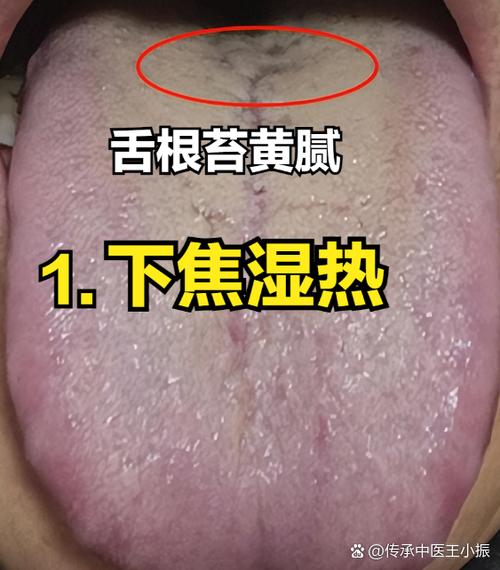 舌苔有黄苔是什么原因