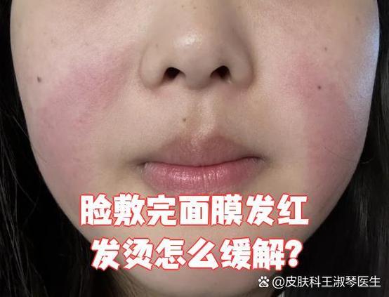 脸发热发红发烫怎么快速解决
