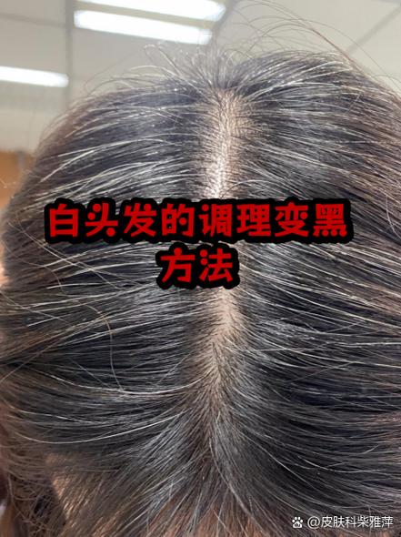 40岁头发白了怎么调理变黑