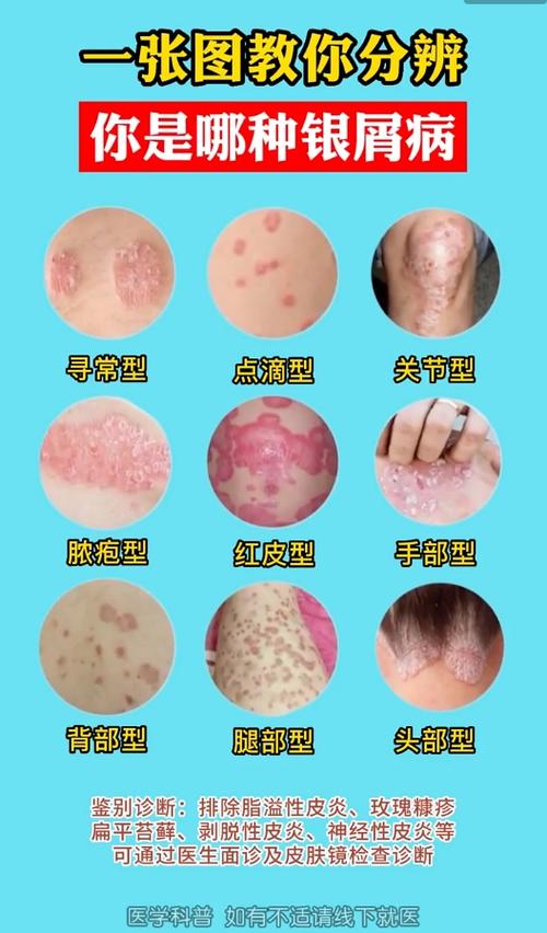 皮肤病识别扫一扫