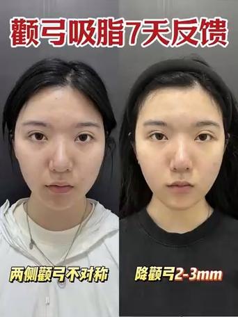 面部吸脂7天恢复图