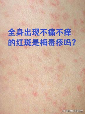 梅毒红斑与普通红斑