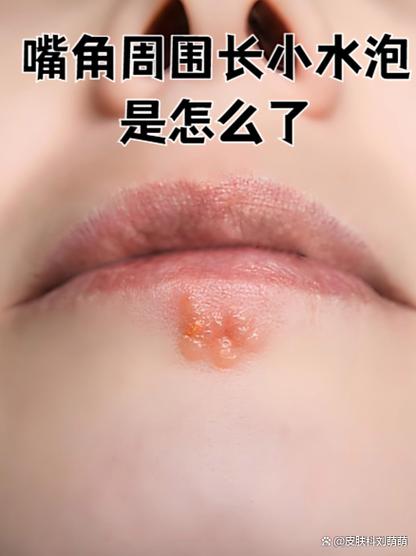 嘴唇上火起泡怎么快速消除