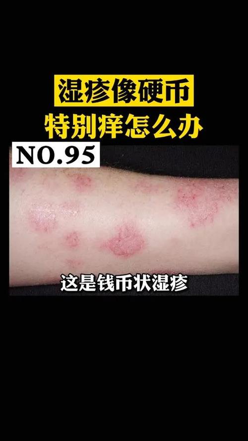 湿疹的图片样子