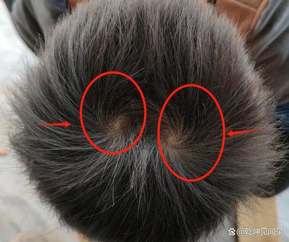 男孩前额头有旋是什么意思