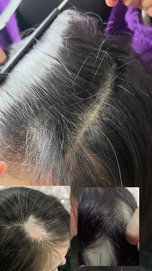 斑秃处长出白色头发正常吗