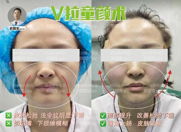 面部提升三件套多少钱