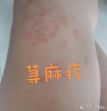 20种皮肤病对照表