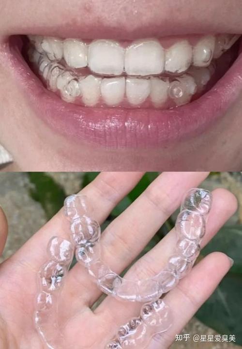 钛金的牙套好不好