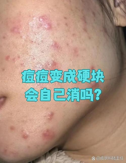 点痘消