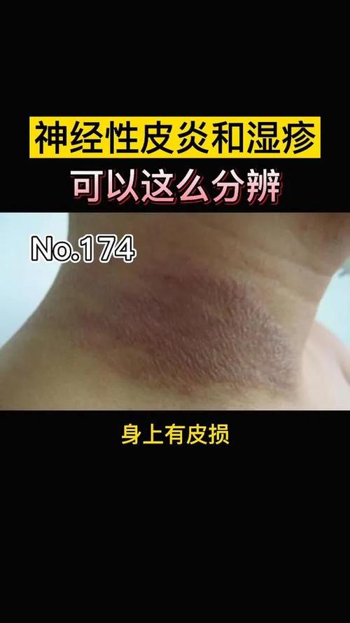 湿疹和皮炎区别