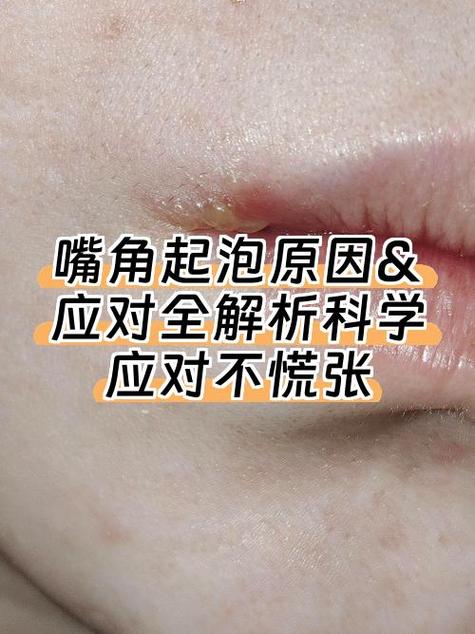 嘴角裂口怎么办
