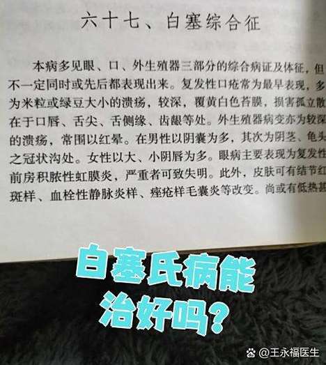 白塞氏能彻底治愈吗