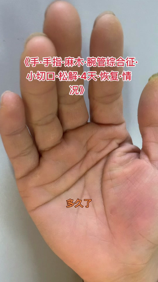 治疗手气的最佳方法
