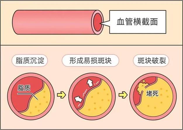 颈动脉斑块吃银杏叶片吃多久
