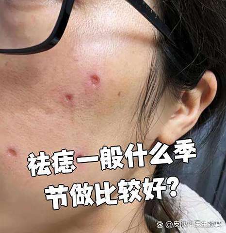祛痣什么季节最好