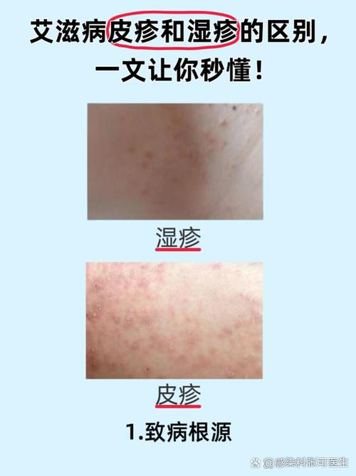 湿疹根除方法