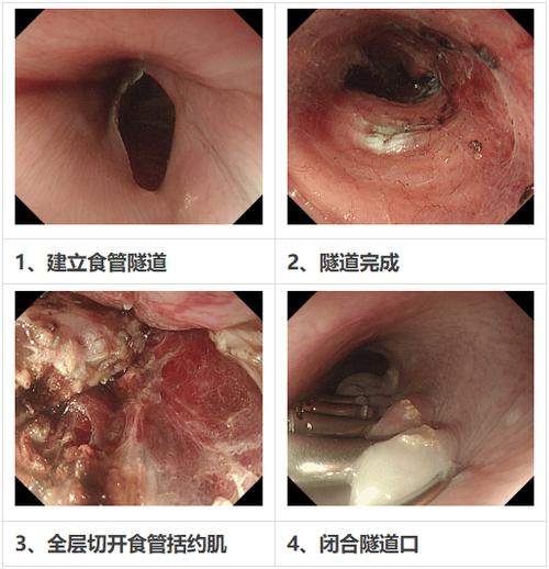 做食道镜疼不疼