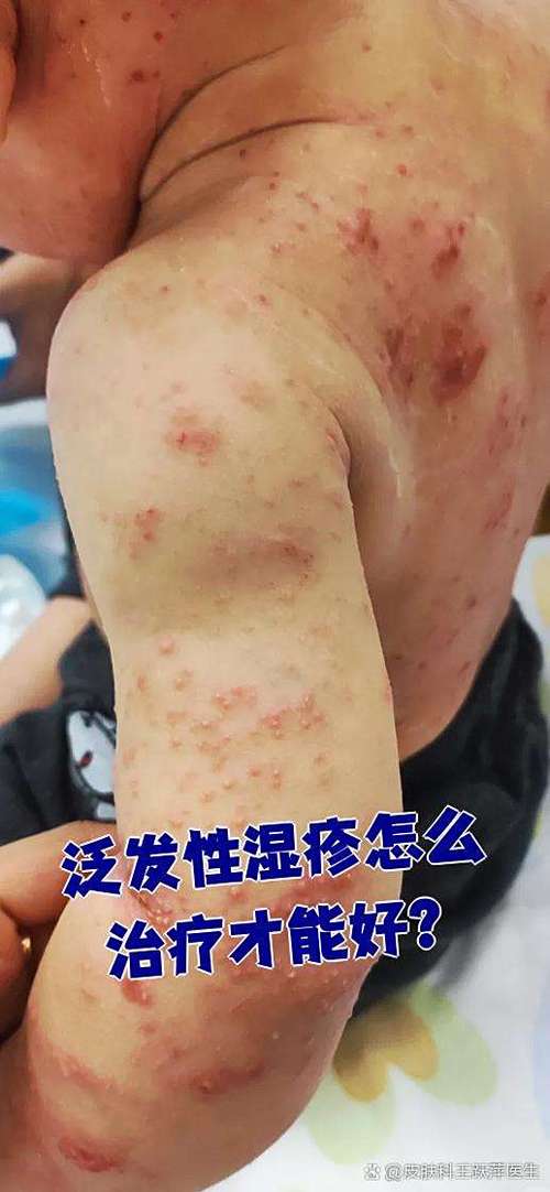 干性湿疹最好根治方法