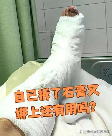 自己拆了石膏又绑上还有用吗