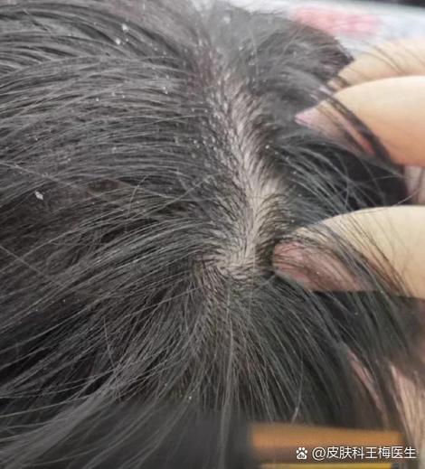 头皮痒抓后出水粘粘的