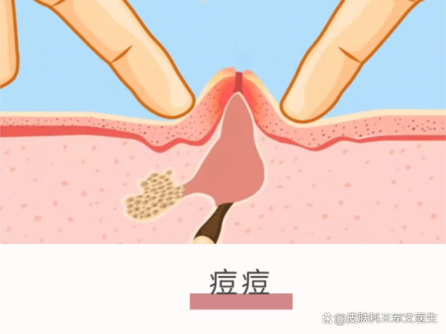 女生说挤痘痘暗示啥意思