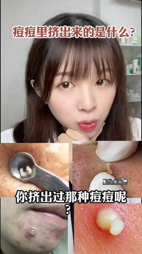情侣间挤痘痘是什么意思