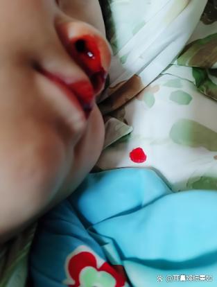 小孩子睡觉莫名流鼻血