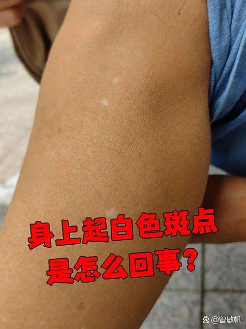 身上有白点点是什么病