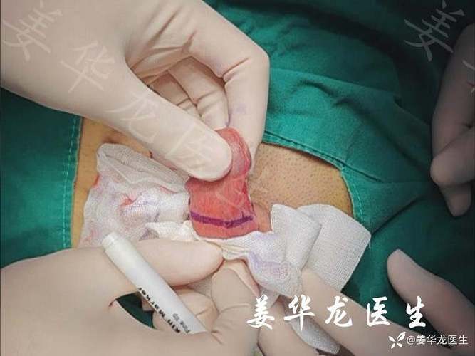 男人割了皮包什么样子