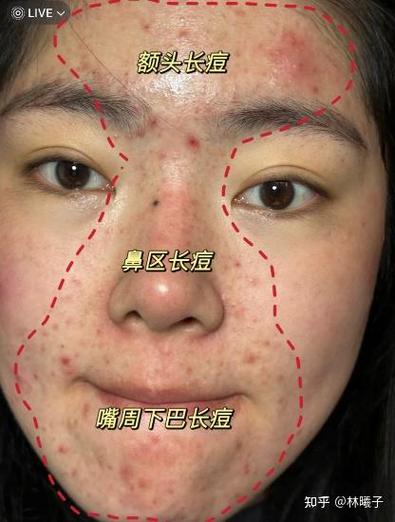 女生长痘怎么哄她开心