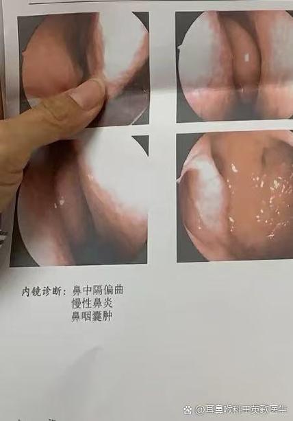 小孩老是流鼻血怎么回事