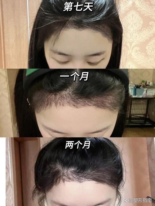植发几个月后是猛长期