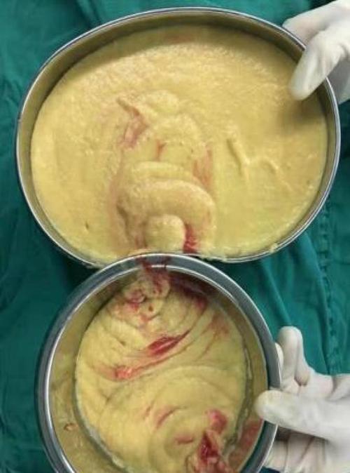 深圳一女子隆胸假体变玉米糊