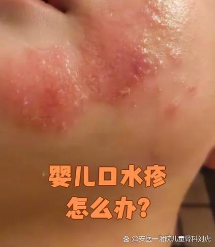 宝宝流口水脸红红的