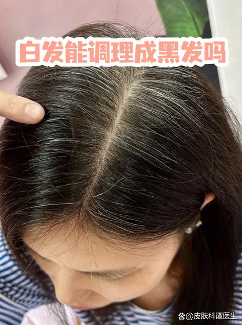 白发能调理成黑发吗
