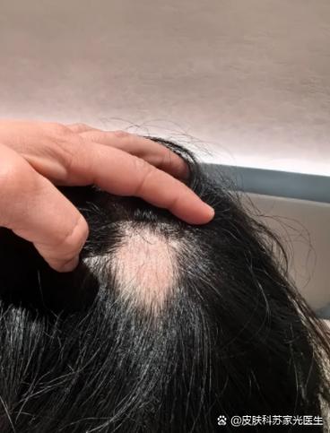 斑秃还能长出头发吗
