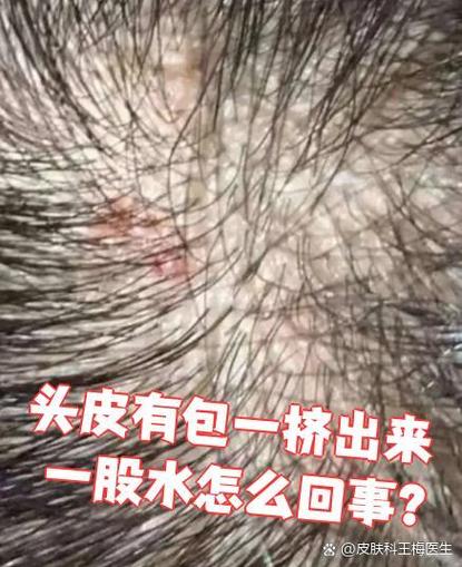 头皮有疙瘩一挤出水