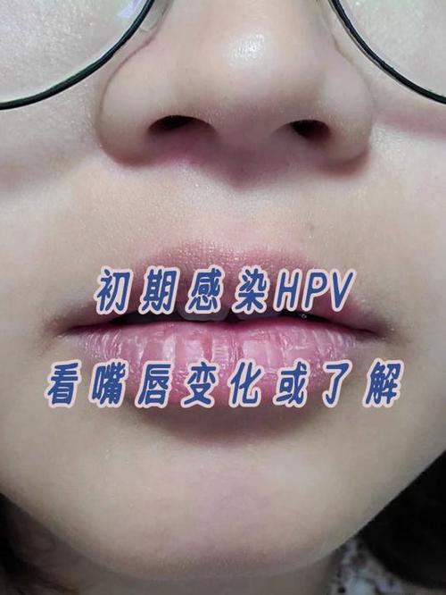 唇部感染hpv的症状