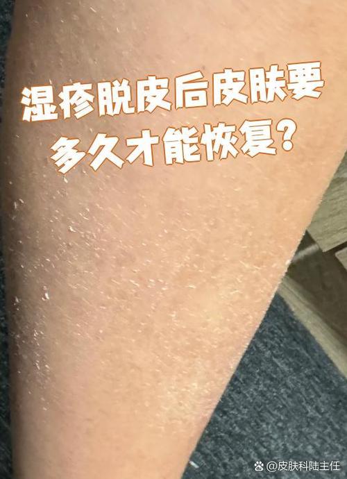 湿疹好转迹象图片